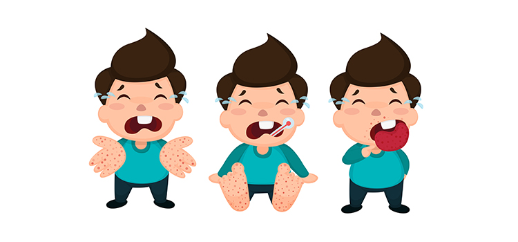 Hand Foot and Mouth Disease (HFMD): How to keep children safe